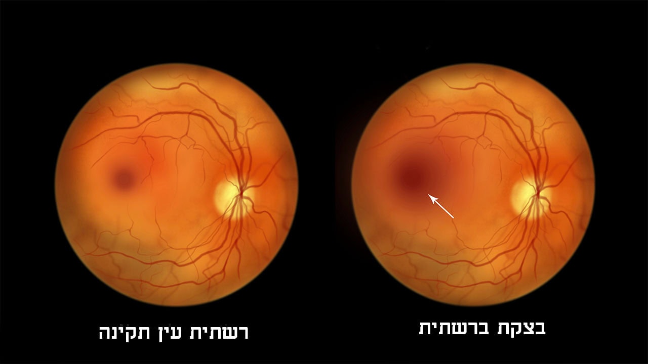 בצקת ברשתית