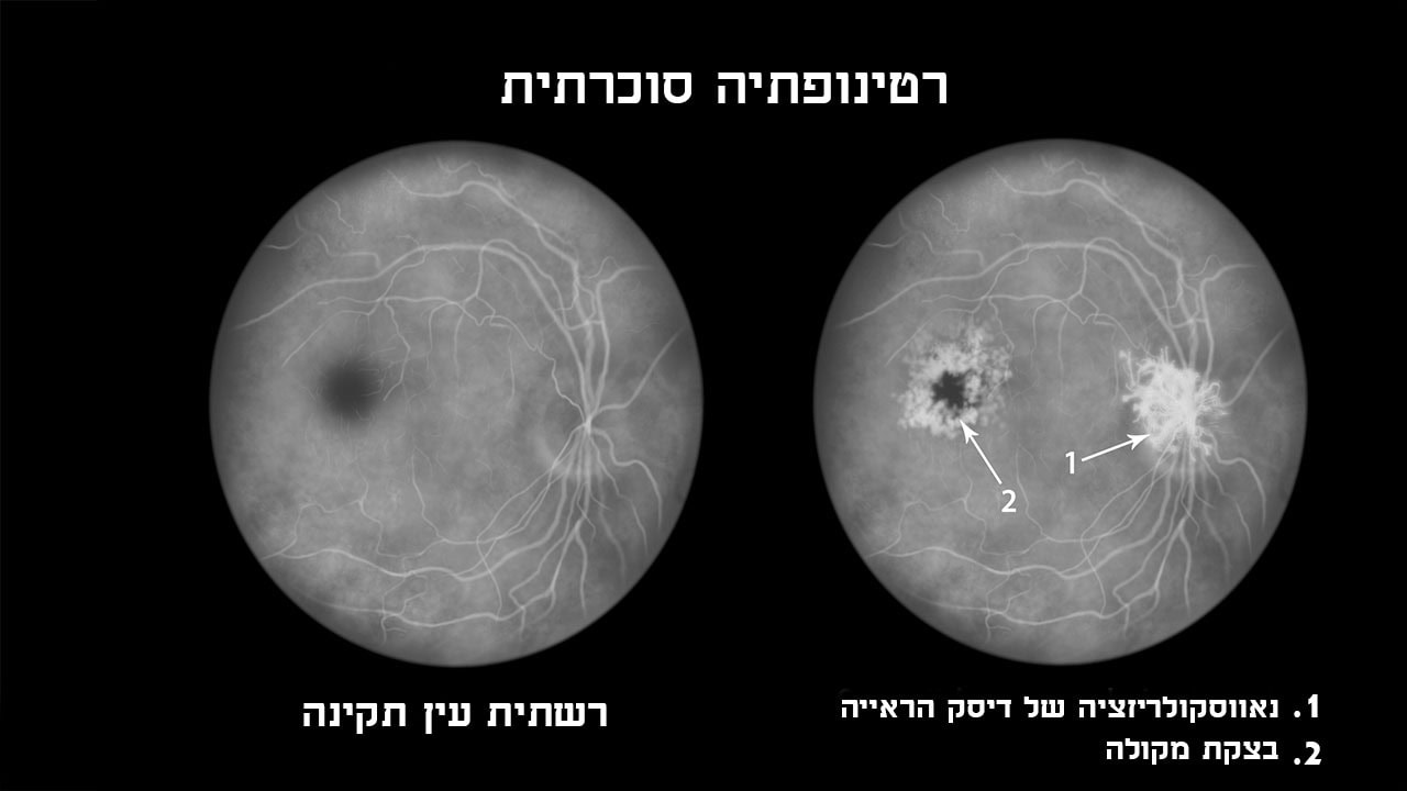 רטינופתיה סוכרתית